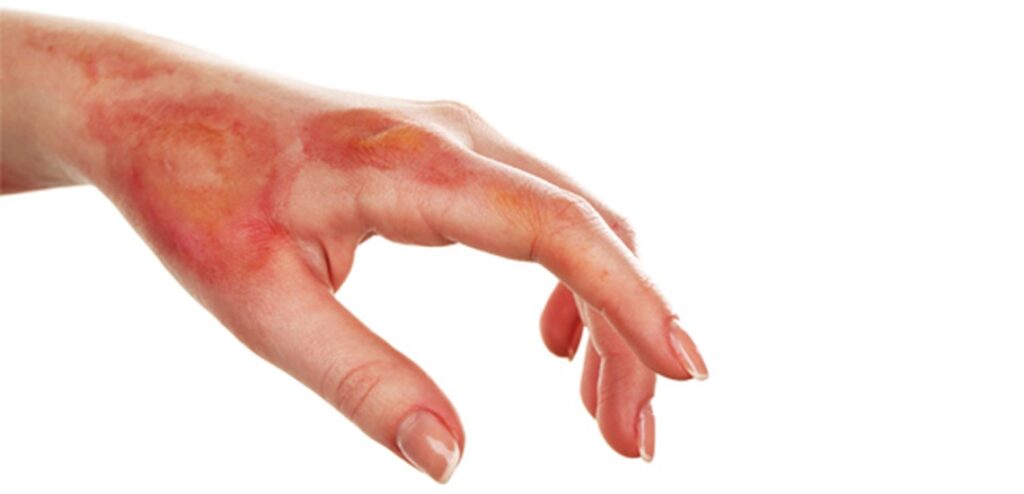 burn scars catastrophic injury